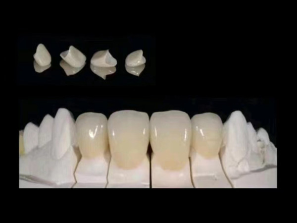 Emax Veneer